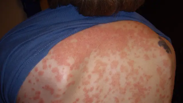 Psoriasis guttate