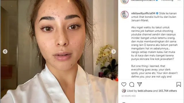 Wajah Nikita Willy penuh dengan jerawat