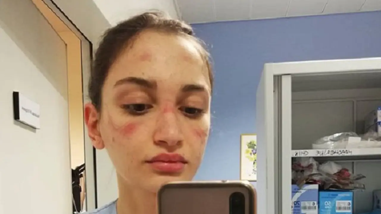 Bonari menunjukkan wajahnya yang tampak memar lantaran memakai masker penutup mata dalam kurun waktu yang cukup lama (alessiabonari_)