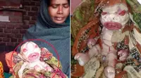 Seorang bayi dari India yang alami kondisi langka