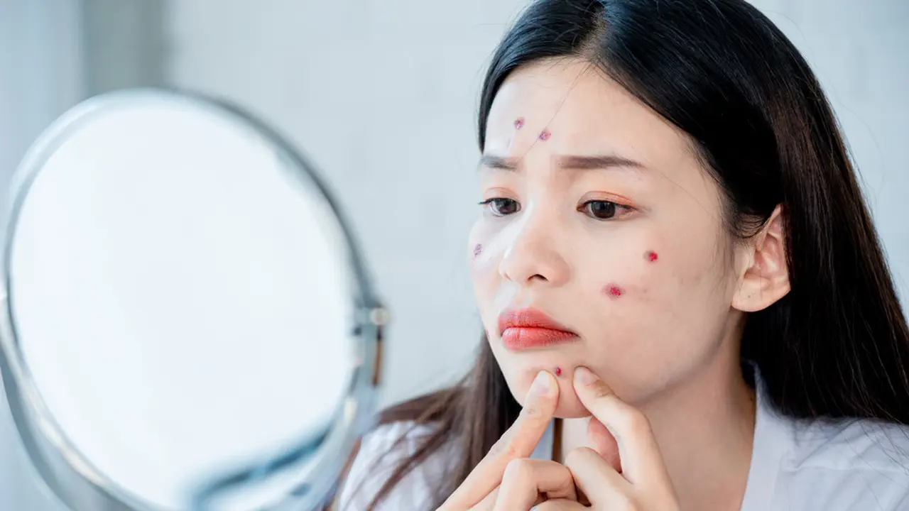 Tips Mengatasi Jerawat Batu yang Sering Bikin Kesal, biar Nggak Meninggalkan Bekas