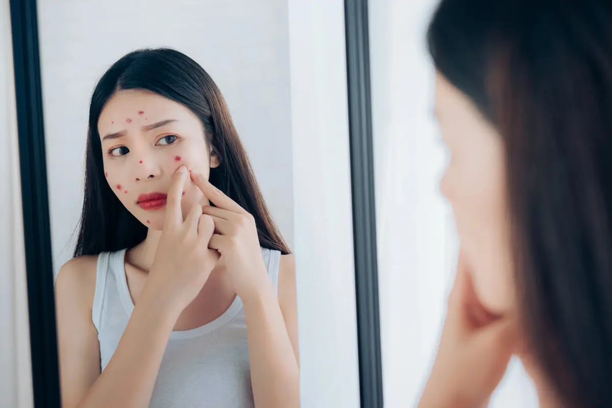 Kenali 7 Penyebab Jerawat Sering Muncul dan Susah Hilang Beserta Solusinya