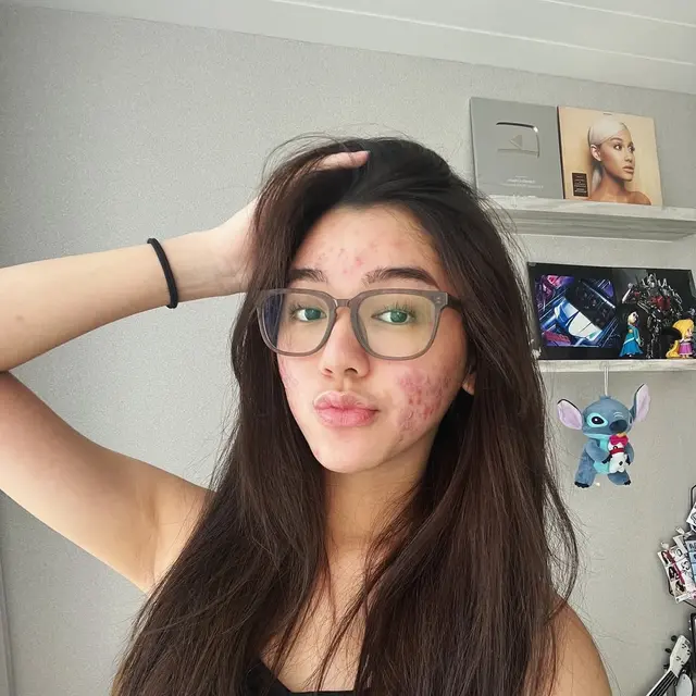 6 Potret Wajah Gabriella Ekaputri Berjerawat, Tetap Percaya Diri Tampil Natural