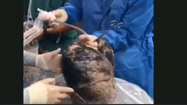 Dokter di Tiongkok tolak paru-paru perokok ini yang menjadi hitam