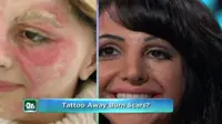 Inilah Hameed, paramedical tatto specialist yang mampu menyamarkan bekas luka dengan tinta tato. Perawatan ini dimulai pada wajahnya sendiri. Foto: CBS News