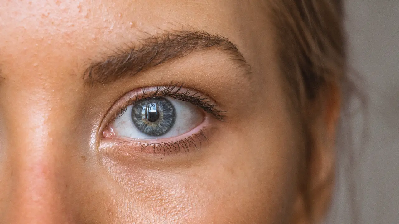 melasma
