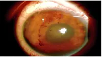 Anak laki-laki asal Meksiko kehilangan penglihatan karena cacing parasit di dalam matanya. (Foto: New England Journal of Medicine)