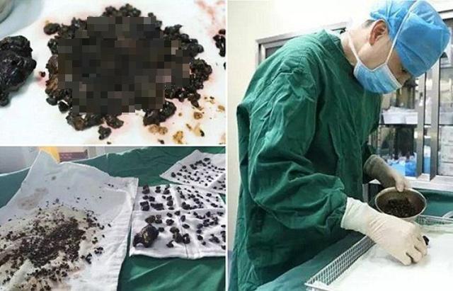 Unduh 99 Koleksi Gambar Ginjal Penuh Batu Paling Baru 