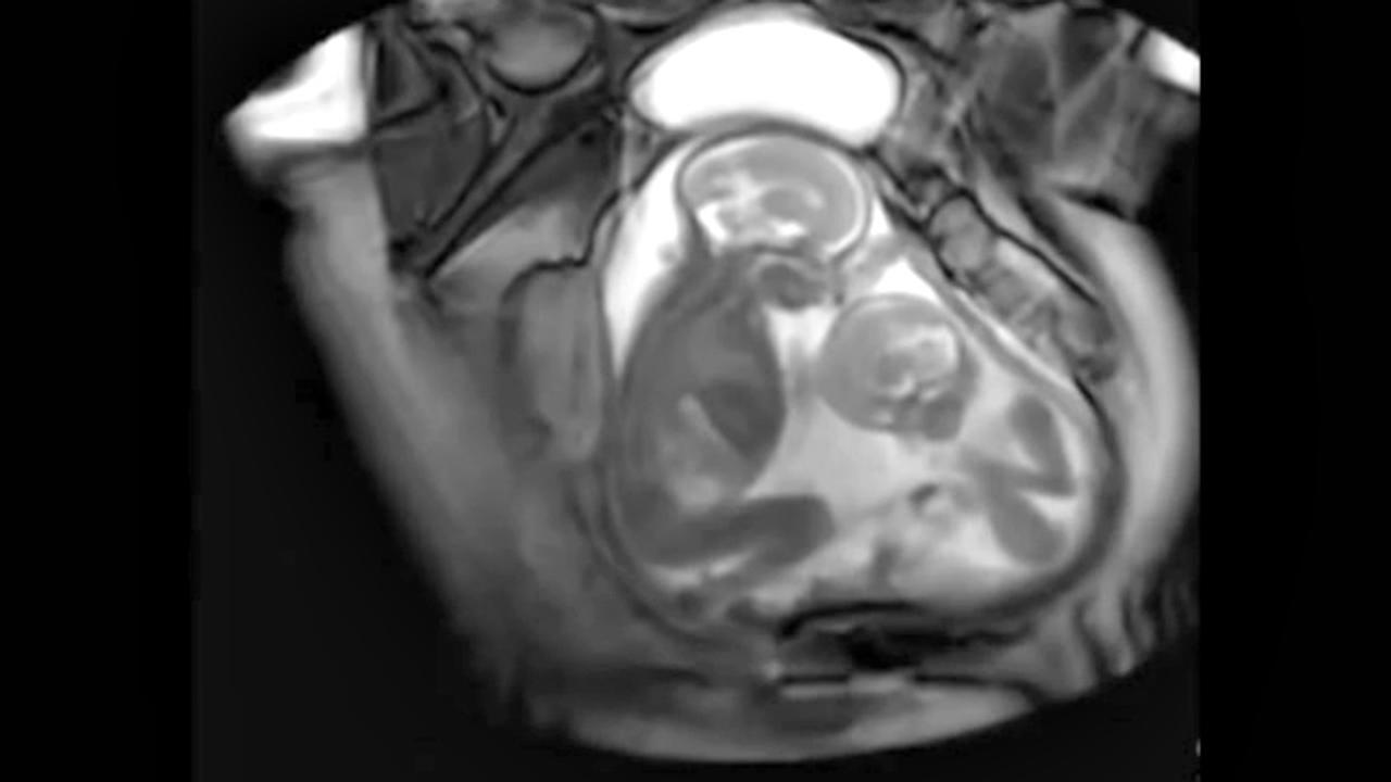 Bayi Kembar Bertengkar Dalam Rahim Ibu 