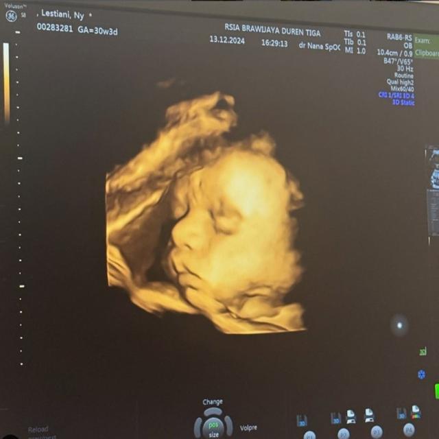 Rizky Billar Bagikan Foto USG Anak Keduanya, Bentuk Hidunganya Jadi Sorotan