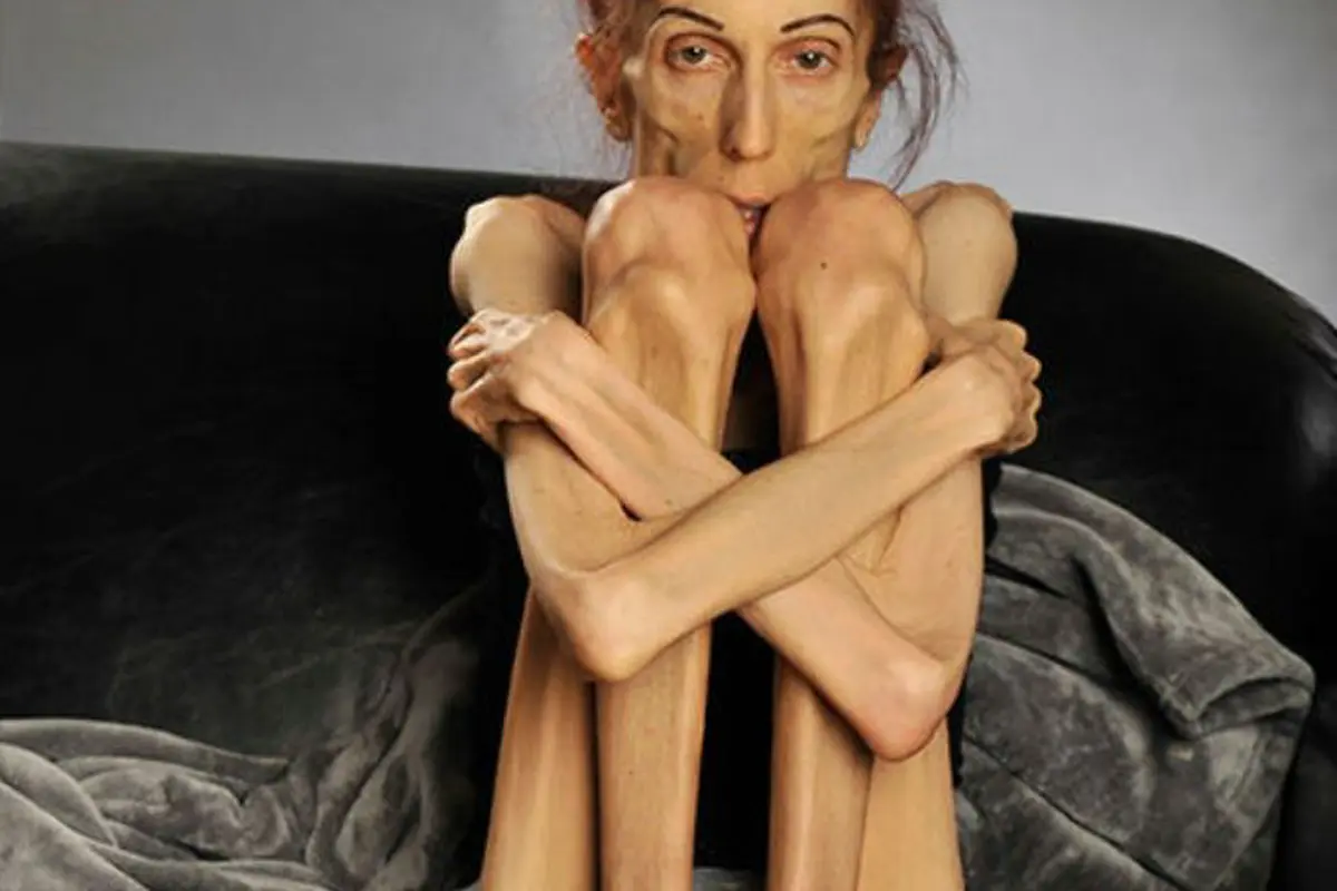 Rachael Farrokh, Penderita Anorexia yang Sekarat dan Ingin Insyaf