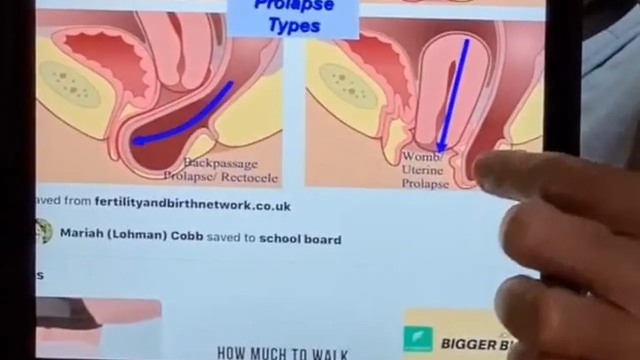Peranakan turun atau prolaps uteri