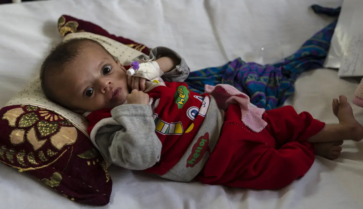 Seorang bayi laki-laki terbaring di tempat tidur saat menjalani perawatan di bangsal gizi buruk RS Anak Nasional Ataturk, Kabul, Afghanistan, 2 Desember 2021. Menurut PBB dari awal November, 8,7 juta orang di Afghanistan hidup mendekati kelaparan. (AP Photo/Petros Giannakouris)