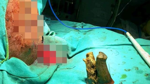 kakek di India miliki tanduk