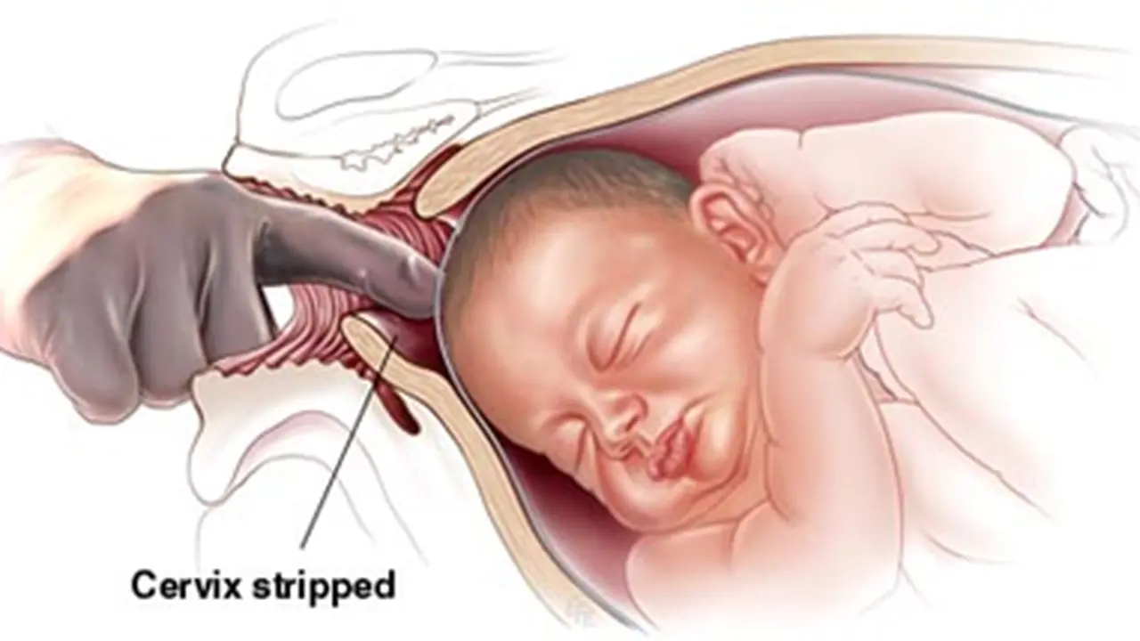 Risiko Pemberian Oksitosin Sintesis Dikombine Dengan Epidural