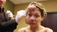 Jennifer menderita karena Arteriovenous Malformation (AVM) yang membuat permukaan wajahnya menggembung seperti balon-balon kecil