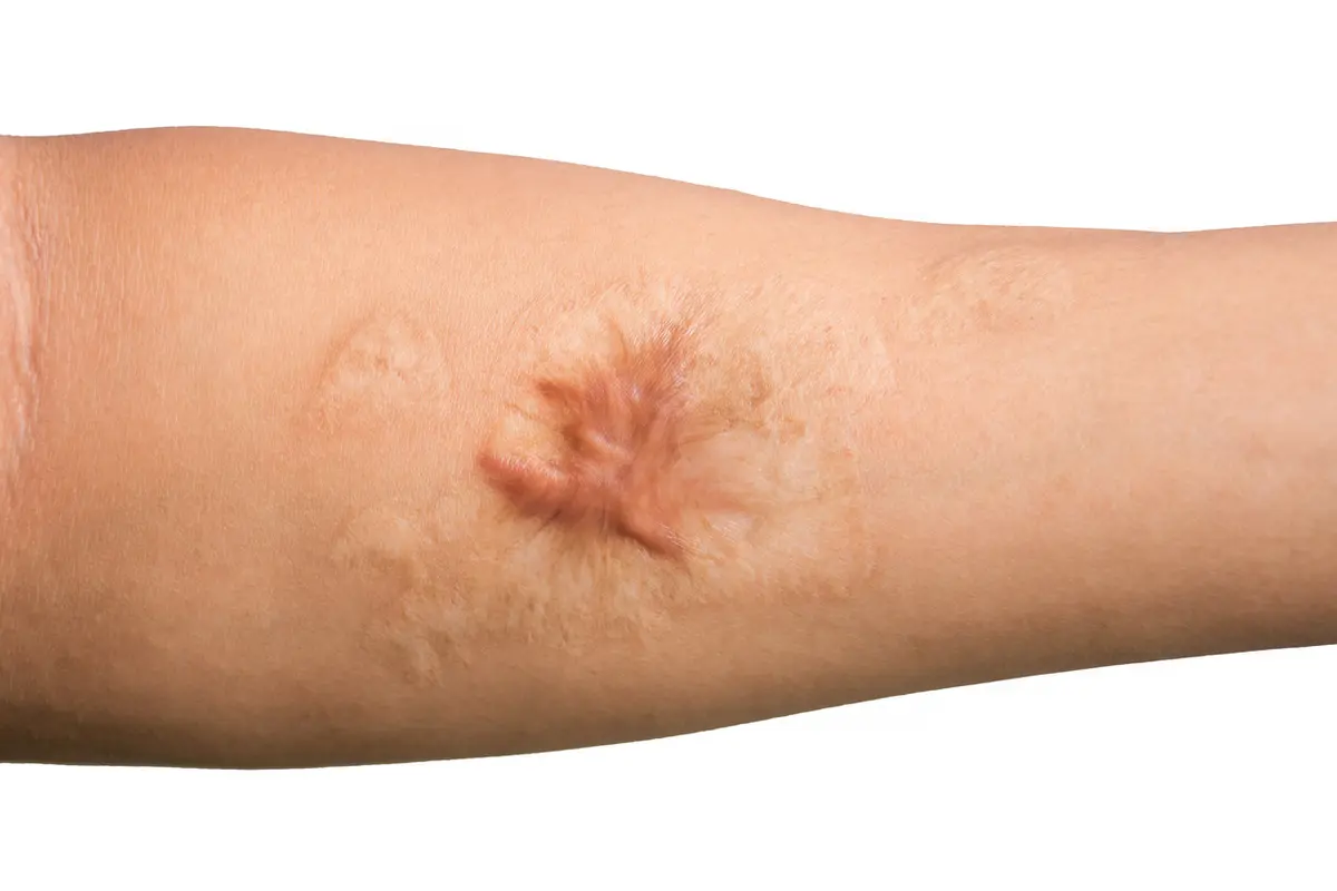Cara Menghilangkan Keloid