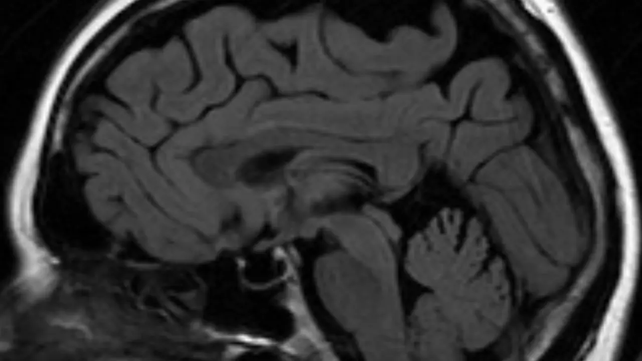 Empty Sella Syndrome