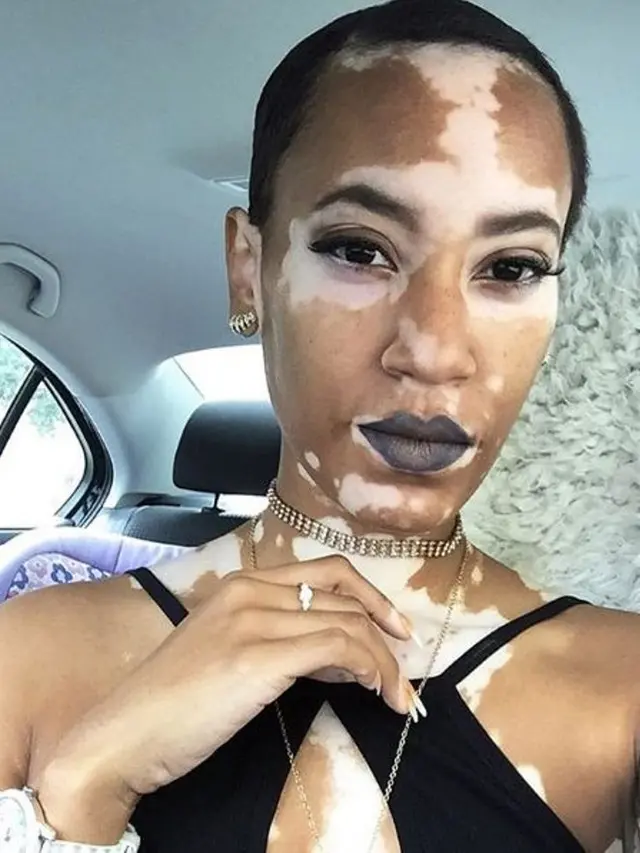 [Bintang] Menderita Vitiligo, Amy Deanna Berhasil Jadi Model yang Mendunia