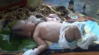 Tubuh mungil Wahyuni Aritonang hanya bisa terbaring lemas. Bayi yang baru berusia beberapa bulan itu harus menahan sakit atas pembengkakan pembuluh darah. (Istimewa)