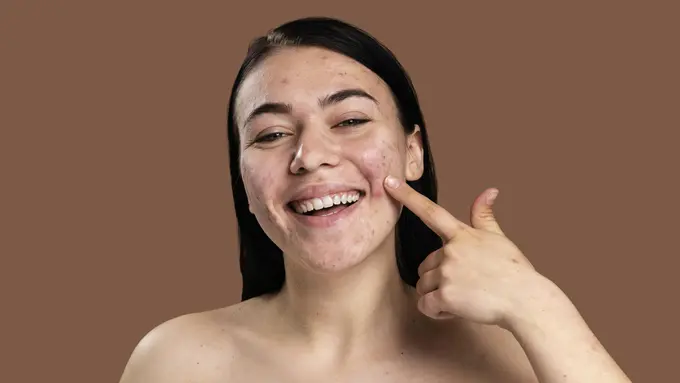 Ilustrasi jerawat
