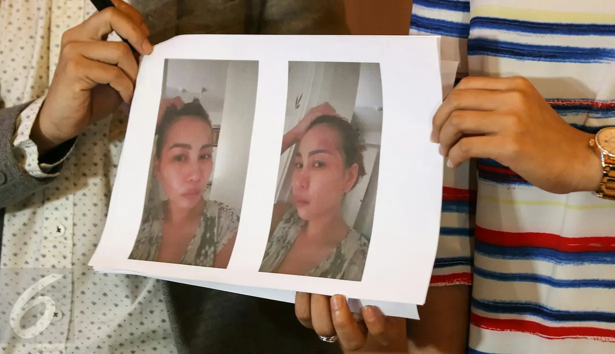 Istri Norman Kamaru, Cici Daisy Paindong menggelar konferensi pers terkait Kekerasan dalam Rumah Tangga (KDRT), Jakarta, Senin (15/2/2016). Cici menunjukkan bukti KDRT yang dialaminya. (Liputan6.com/Yoppy Renato)