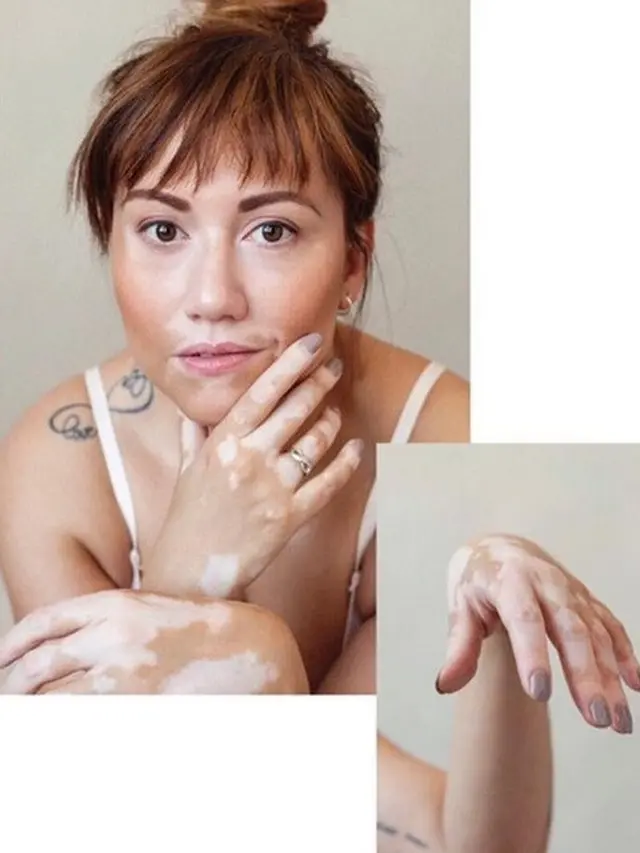 model vitiligo