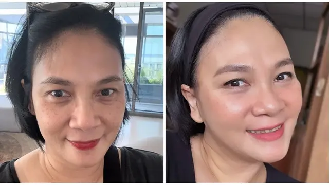 6 Potret Dian Nitami Pasca 3 Minggu Oplas Face Lifting, Kerutan Wajah Berkurang