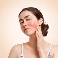 Bekas jerawat kemerahan (PIE). (c)&nbsp;Steklo_KRD/Depositphotos.com