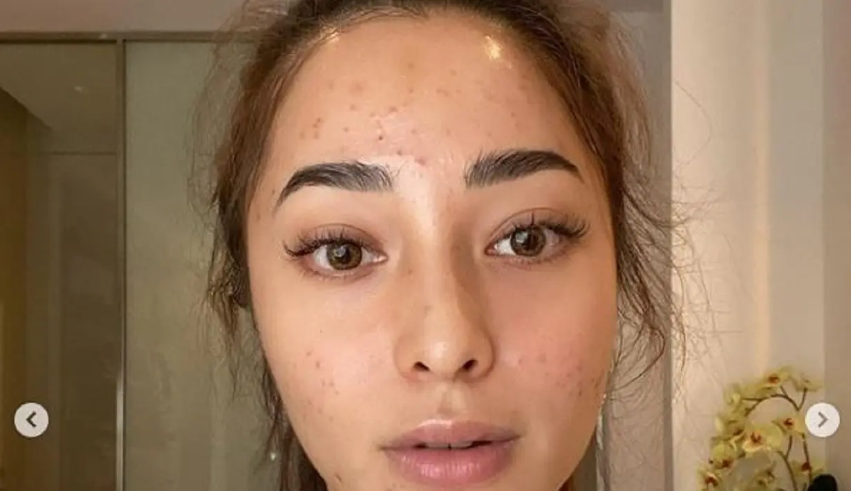 Nikita Willy sempat menangis saat wajahnya penuh jerawat bahkan tak mau menerima pekerjaan (dok.instagram/@nikitawillyofficial94/https://www.instagram.com/p/CONe-G3g17b/Komarudin)