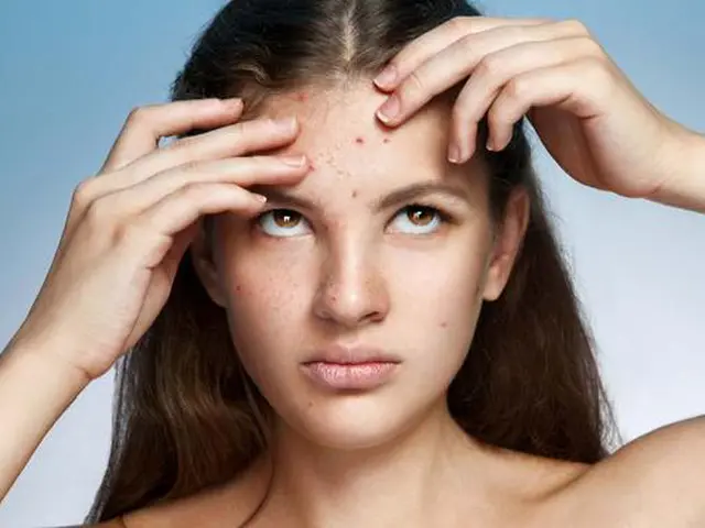Cara Menghilangkan Jerawat Pasir Dan Bekasnya Di Dahi Secara Alami Dan Cepat Beauty Fimela Com
