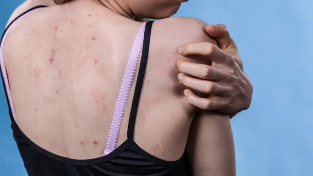 Jerawat di Punggung
