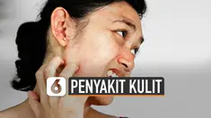 Kelembapan udara akan meningkat saat musim hujan. Kondisi tersebut picu sejumlah masalah penyakit kulit.