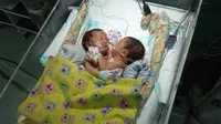 Berat badan bayi kembar siam Salma-Sovia sempat turun dalam masa kritis 28 hari yang ditetapkan dokter. (Liputan6.com/Dian Kurniawan)