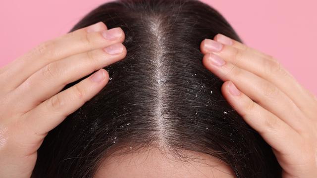 Kenapa Sih Rambut Mudah Bau Tak Sedap Padahal Sudah Keramas? Ternyata Ini Alasannya!