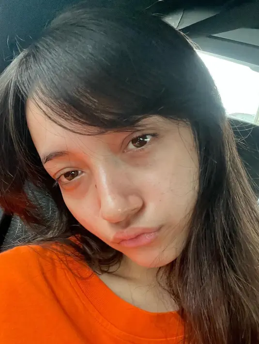 Namun ia tak menyerah sebagai acne fighter. Dengan perawatan dan mental yang makin kuat, ia bisa membersihkan acne dari wajah. [Instagram @megandomani1410]