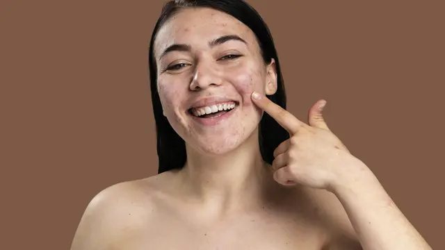 Ilustrasi memencet jerawat