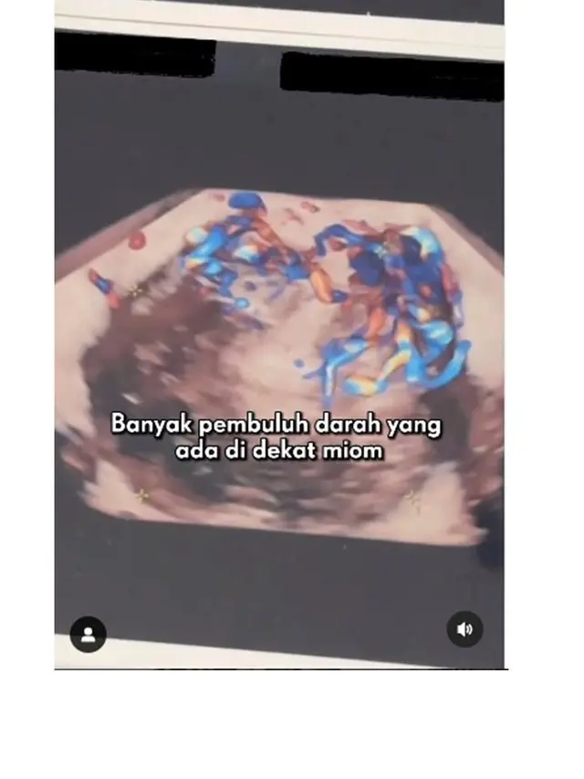 12 Potret Kondisi Alice Norin Usai Divonis Kanker Sarkoma, Terpaksa Menopause Dini