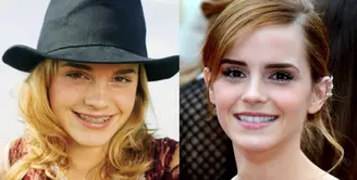 Emma Watson menggunakan kawat gigi di awal kariernya. (Pinterest)