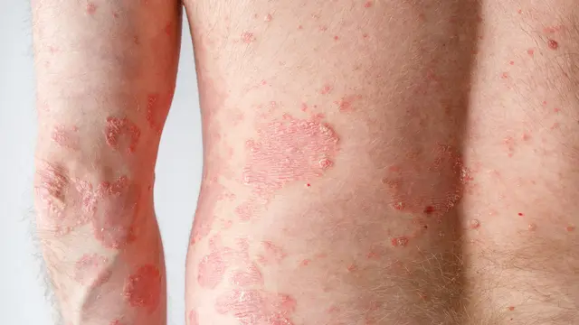 Papula psoriasis vulgaris
