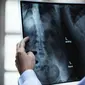 ilustrasi gejala yang ditimbulkan osteoporosis/freepik.com