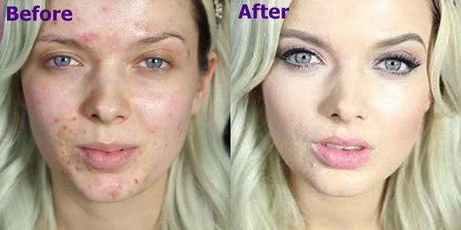 Muka Berjerawat? Tenang, Bisa Ditutup dengan Makeup Kok! - Beauty Fimela.com