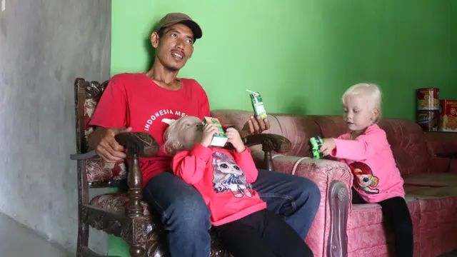 Nadira dan Nadya Kembar Albino di Wonogiri