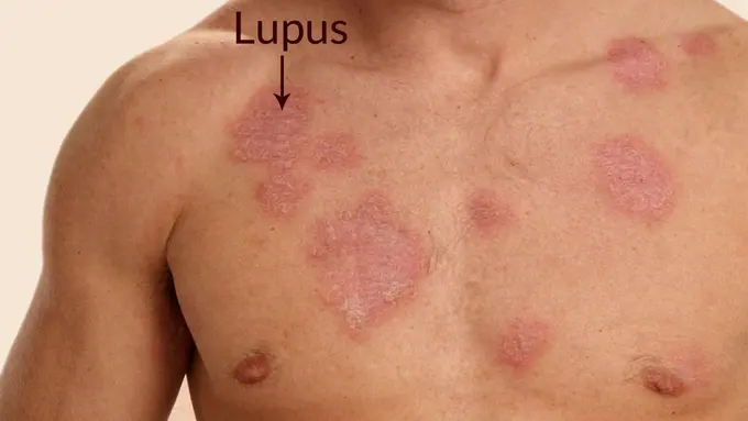 7 Fakta Tentang Penyakit Lupus yang Mungkin Belum Kamu Ketahui