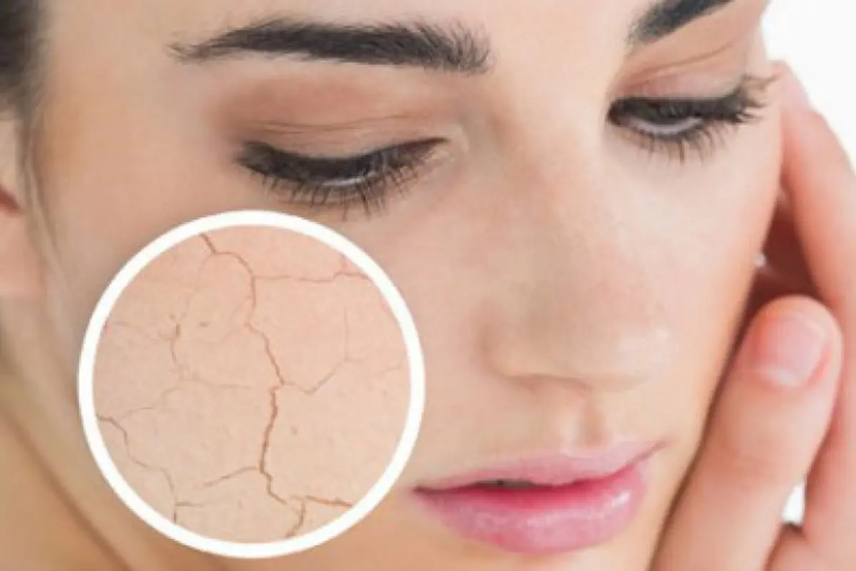 5 Cara Mengejutkan untuk Memerangi Kulit Kering