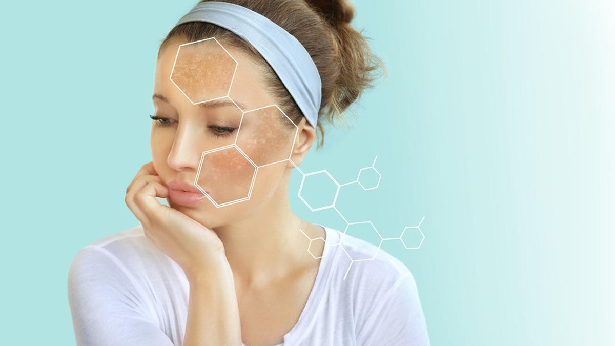 Apa Itu Hiperpigmentasi? Kenali Penyebab dan Cara Mencegah yang Efektif