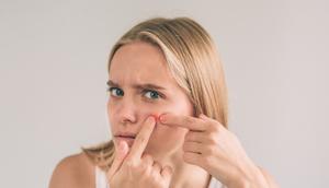 Ilustrasi Jerawat Pada Wajah Credit: freepik.com