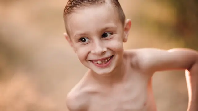 Cara Mencegah TBC pada Anak Stunting, Kenali Penyebab dan Risiko Berbahaya Terhadap Anak