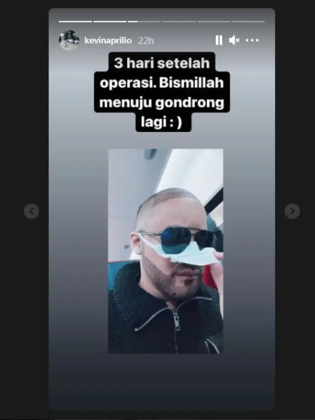 Kevin Aprilio Transpalasi rambut dan bewok