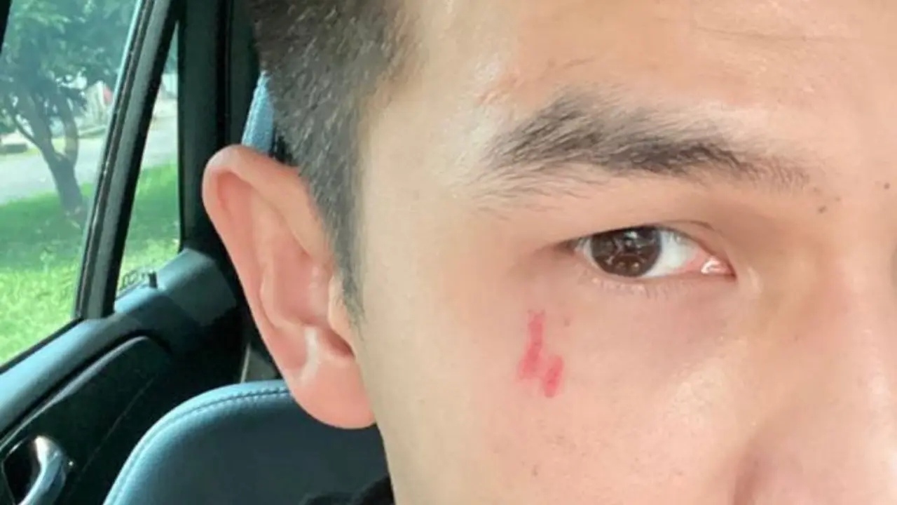 Foto Jonathan Frizzy dengan bekas luka cakar yang diunggah Benny Simanjuntak (https://www.instagram.com/p/CUC3kajpDT1/)